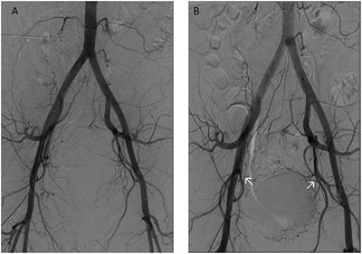 Endometriotic Mass After Hysterectomy in a 61 Year Old Post-menopausal Woman: A Case Report and Update